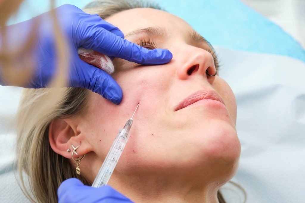 facial lifting with hyaluronic acid applied with a cannula
